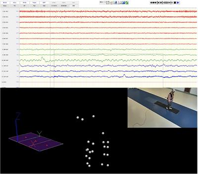 Synchronized Intracranial Electrical Activity and Gait Recording in Parkinson’s Disease Patients With Freezing of Gait